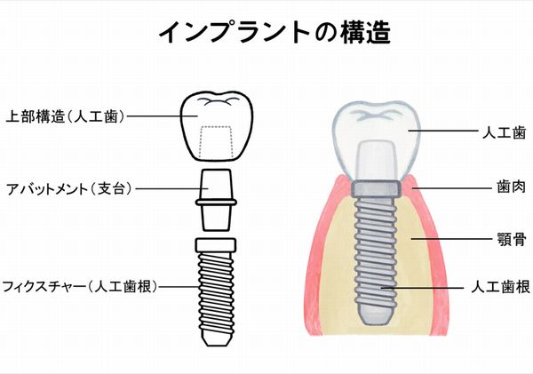 インプラントの構造