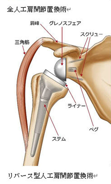 「全人工肩関節置換術」と「リバース型人口肩関節置換術」／（森先生提供）（Ｃ）日刊ゲンダイ