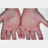 手足口病による手の発疹（Ｃ）Science Photo Library／共同通信イメージズ